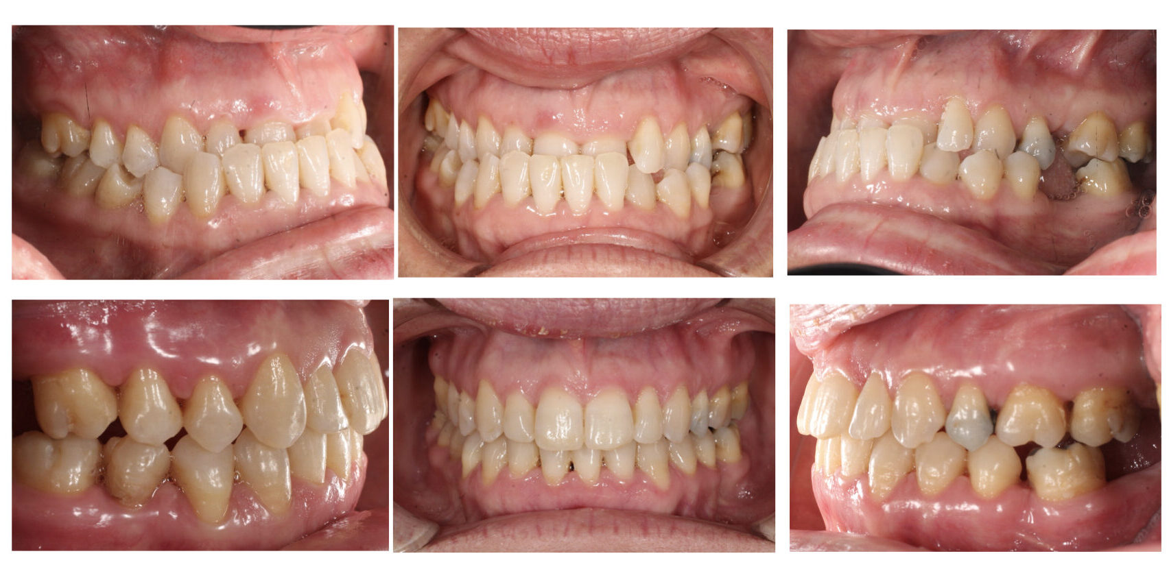 tratamiento ortodoncia: Antes y después de casos reales