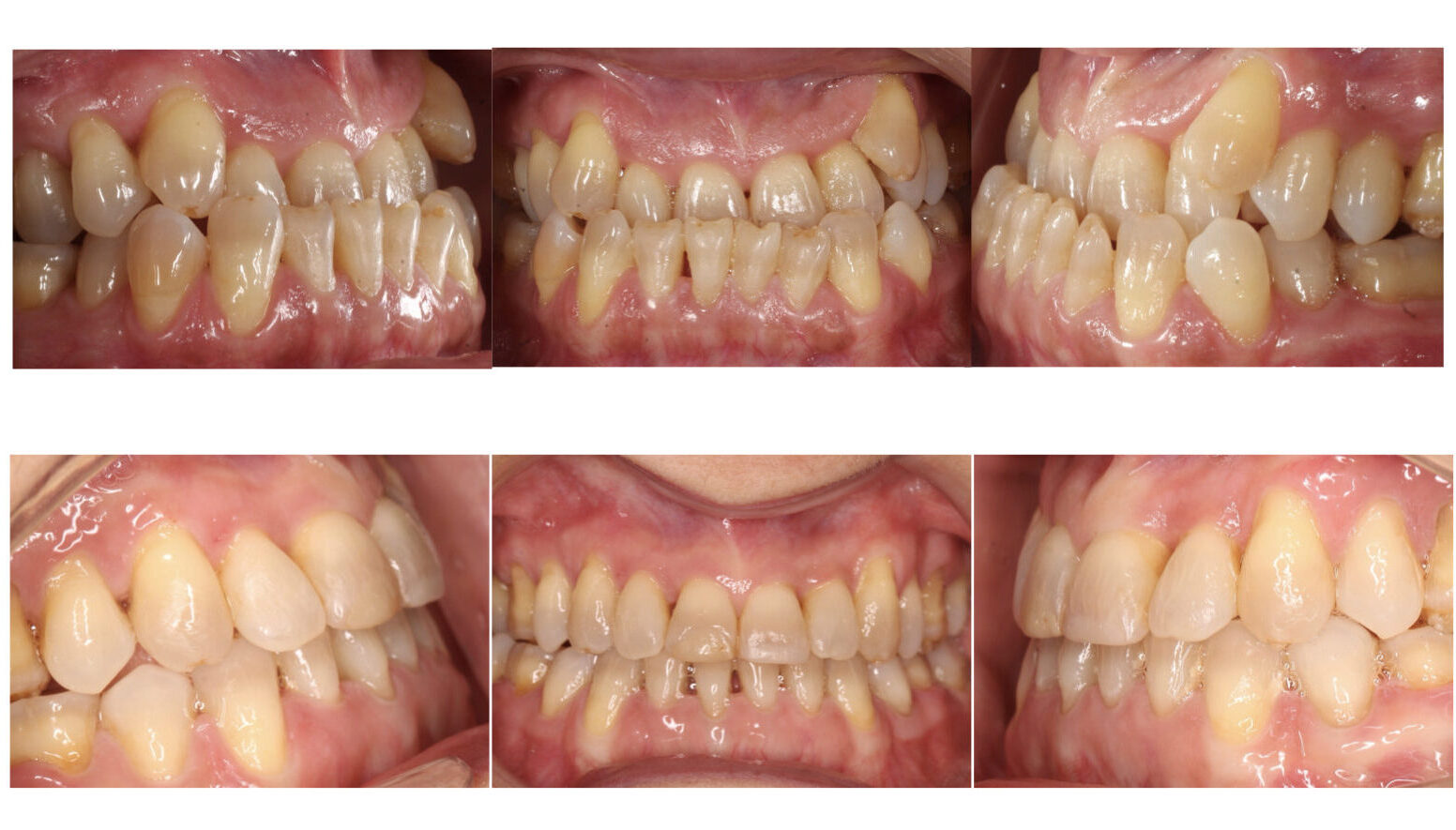 tratamiento ortodoncia: Antes y después de casos reales