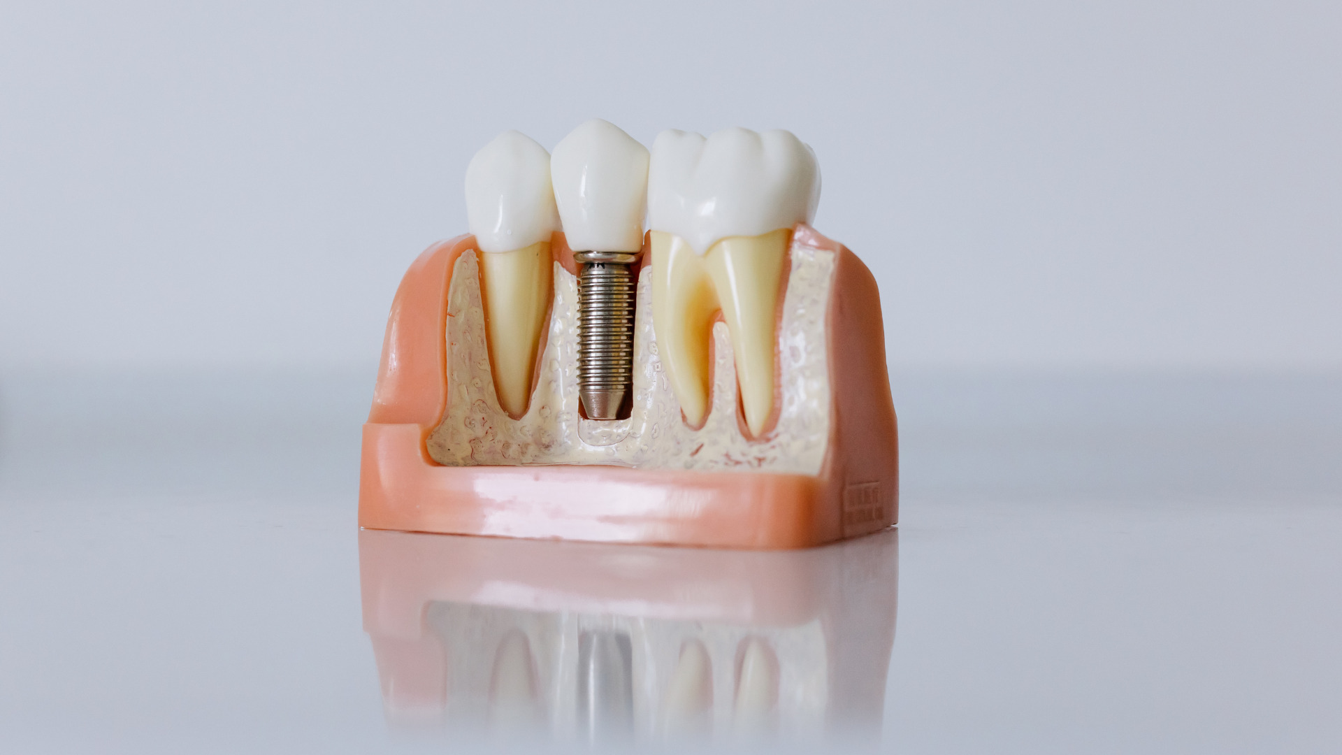 Transforma tu sonrisa con implantes en Valencia: Cómo conseguir los dientes perfectos que siempre has deseado